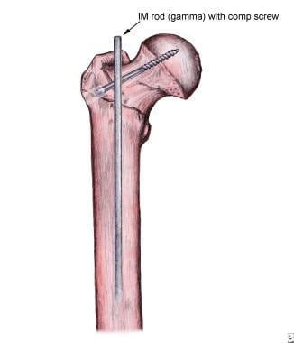 Femur with intramedullary rod and screw. 