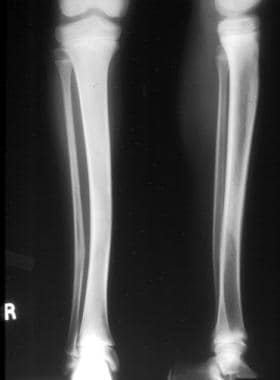 Anteroposterior and lateral radiograph of a 9-year