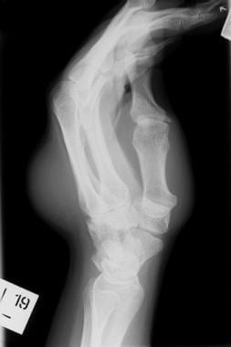 Lateral radiograph depicts a synovial sarcoma of t