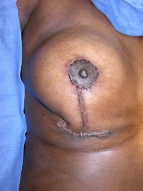 Breast Reduction with L Scar After 30 Years: Indications and