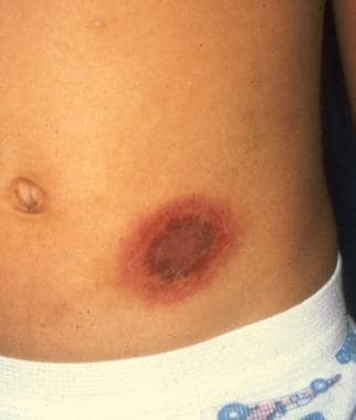 Targetoid fixed drug eruption on the abdomen of a 