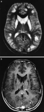 (a) T2-weighted axial MRI showing hyperintense les