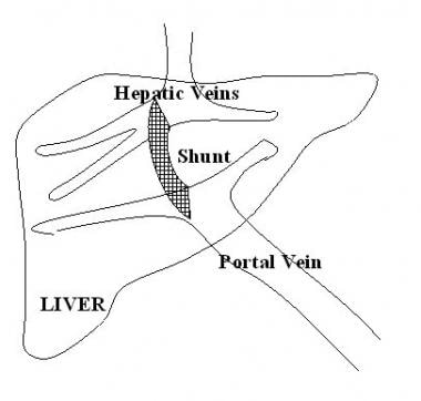 Transjugular intrahepatic portosystemic shunt (TIP