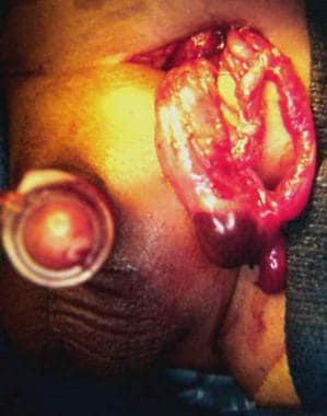 Testis at operation in 2-month-old boy with histor