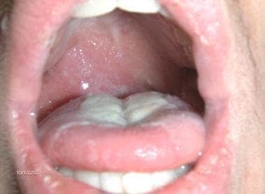 Right peritonsillar abscess. Soft palate, which is