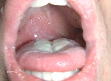 asymmetrical tonsils