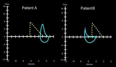 2例患者的呼气流量及容积曲线