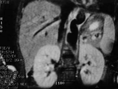 Takayasu指出动脉炎。15岁腹部冠状MRI