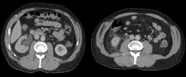 Axial CT images with intravenous contrast, reveali
