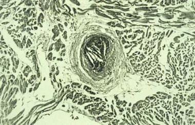 Cholesterol crystal embolization from upstream cor