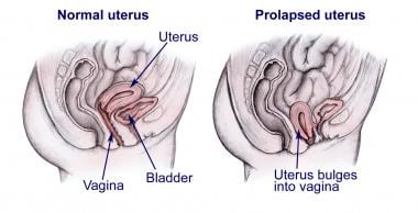 Normal uterus versus a prolapsed uterus. 