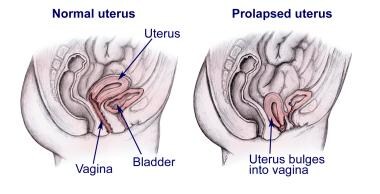 women prolapsed uterus