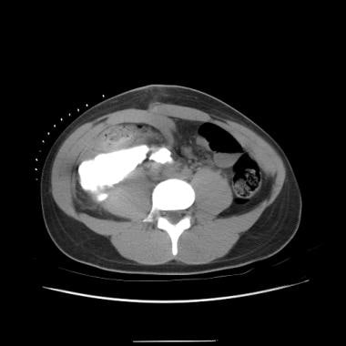 Contrast-filled urinoma. 