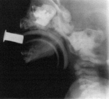 Choanal atresia. Rhinogram demonstrating blockage 