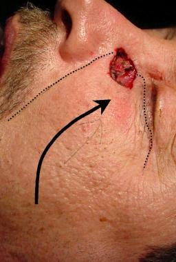 Lesion at junction of nasal sidewall and cheek. A 