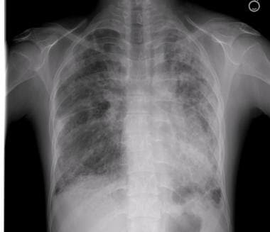 Chest radiograph revealing diffuse, coarse interst