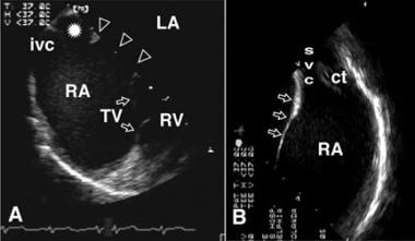Panel A is a transesophageal echocardiogram, trans