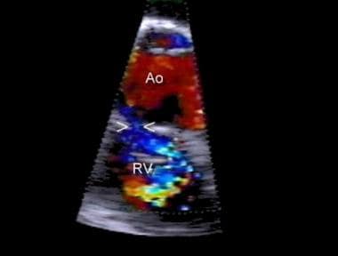 Transesophageal horizontal view of aortic root and