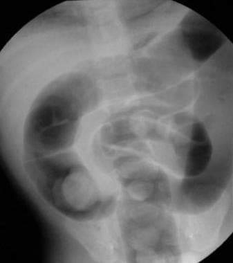 Air contrast enema shows intussusception in the ce