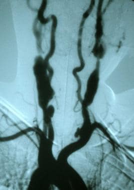 Symptomatic Takayasu arteritis involving both comm