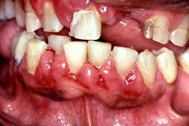 Gingival enlargement in a 41-year-old man with a s