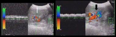 Spectral Doppler and Color Doppler ultrasound show