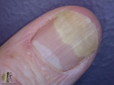 Nail psoriasis Pusztuláris