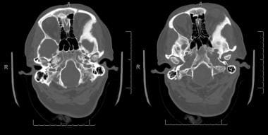 CT scan brain bone window showing intraosseous men