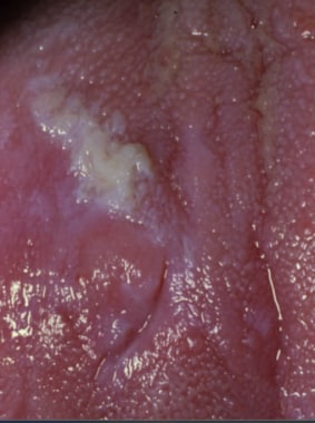 idiopathic leukoplakia