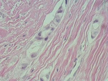 Breast cancer with an Indian file pattern of metas
