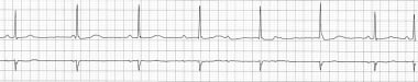 Atrioventricular Dissociation. Significant slowing