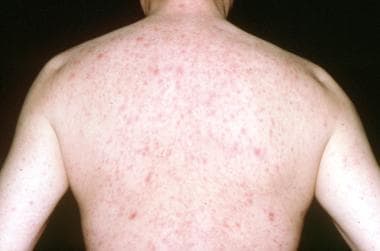 Dermatitis rash viral disease with immunodeficiency on body of