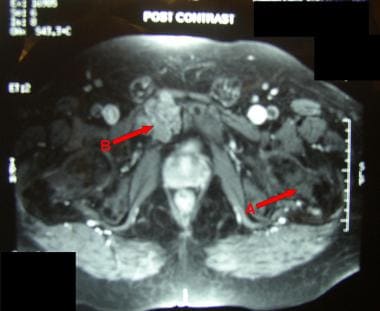 MRI showing chondroma (A) and low-grade chondrosar