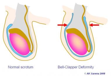 Normal testis (left). Bell clapper deformity (righ
