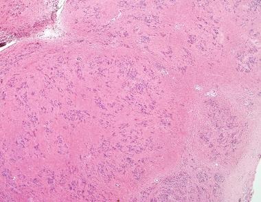 Subependymoma. At low power, these lesions charact
