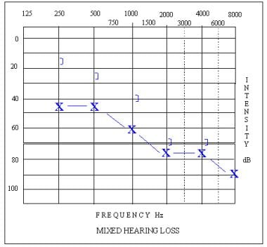 Audiogram depicting a mixed sloping hearing loss i