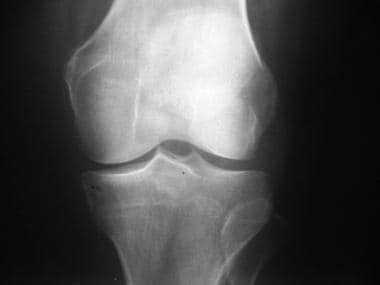 Osteoarthritis of the left knee, Kellgren stage II