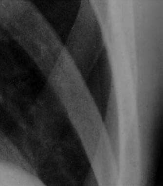 Close radiographic view of patient with small spon