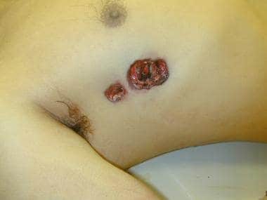 Atypical gunshot wounds of entrance. 