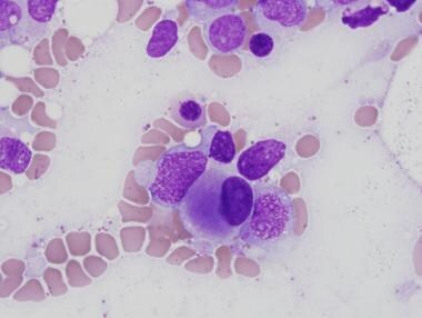 Pathology of therapy-related myeloid neoplasms. Mi