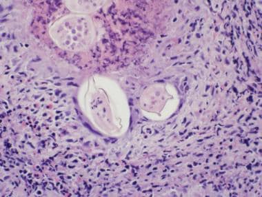 Pathology of Cystitis. Schistosoma-associated cyst