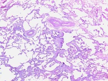 pulmonary fibrosis histology