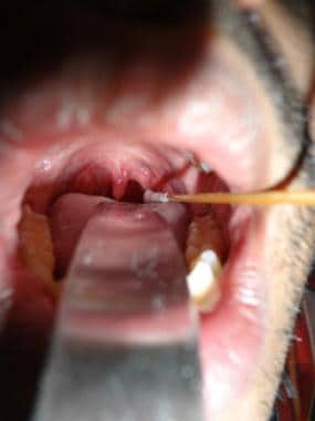Method of obtaining a throat swab 