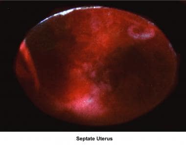 Infertility. Septate uterus. Image courtesy of Jai