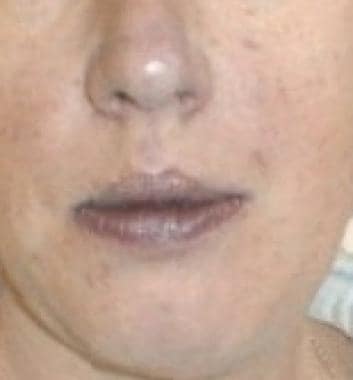 Cyanotic lips in a woman with hypoxia. 