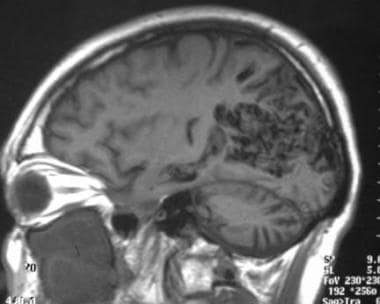 Sagittal T1-weighted MRI showing a large occipital