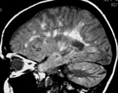 Sagittal proton density–weighted MRI in a patient 