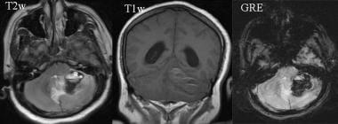 Hemorrhages of various ages are seen in the left c