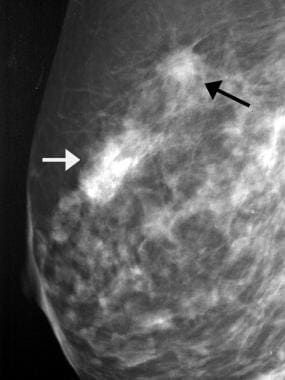 Initial presentation of the patient: (A) double nipple lesions; (B