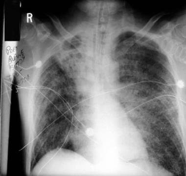 Chest radiograph from a patient with disseminated 